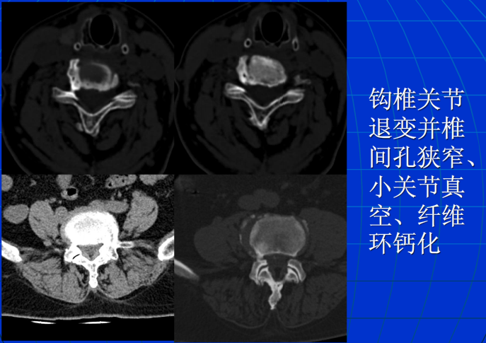 脊柱影像阅读入门