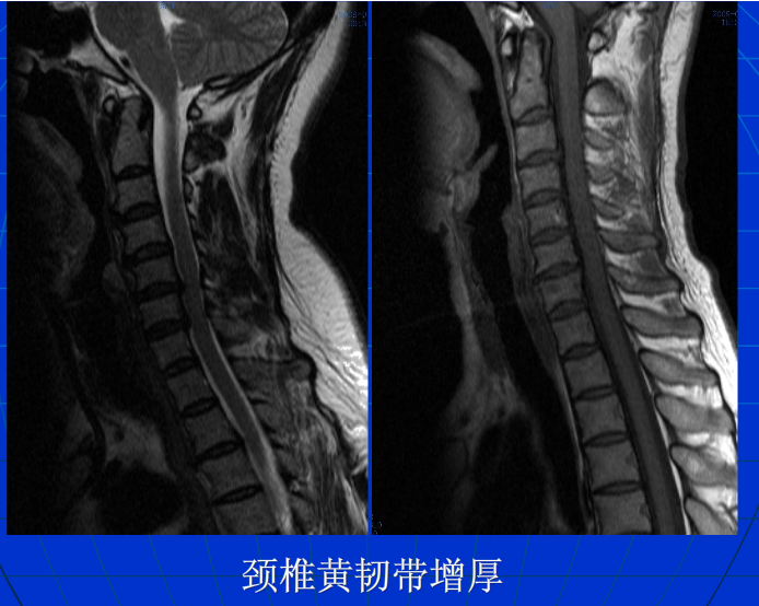 脊柱影像阅读入门
