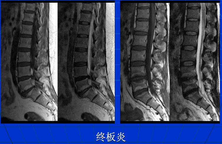 脊柱影像阅读入门