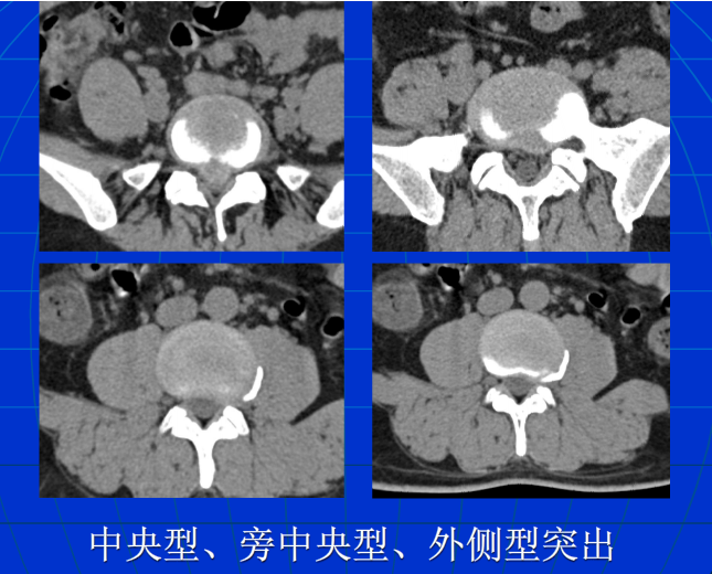 脊柱影像阅读入门