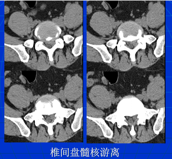 脊柱影像阅读入门