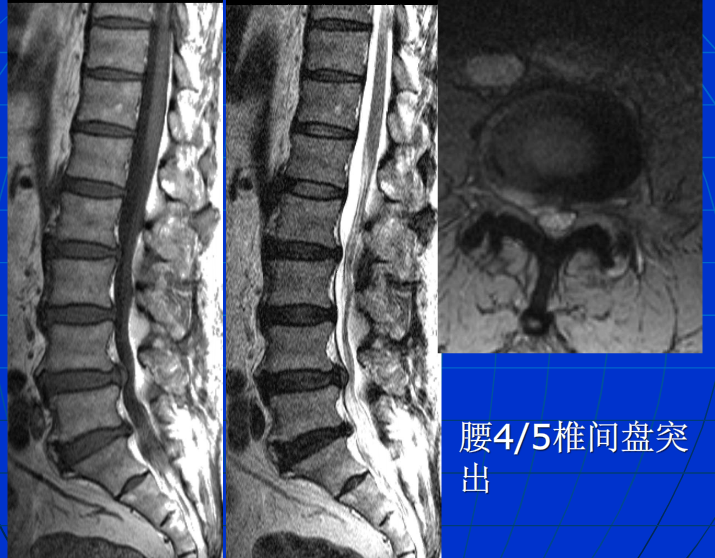 脊柱影像阅读入门