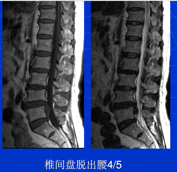 脊柱影像阅读入门