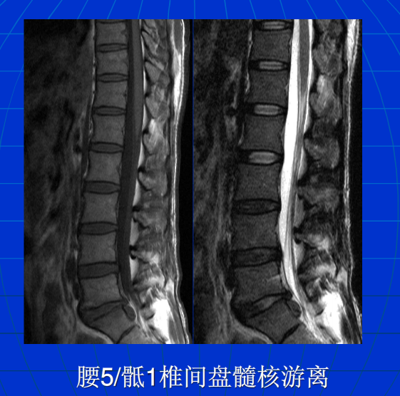 脊柱影像阅读入门