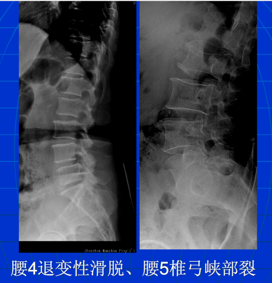 脊柱影像阅读入门
