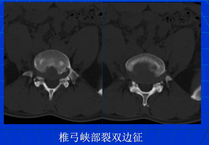 脊柱影像阅读入门