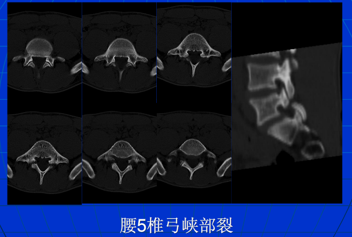 脊柱影像阅读入门