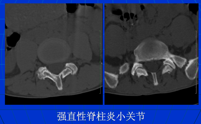 脊柱影像阅读入门