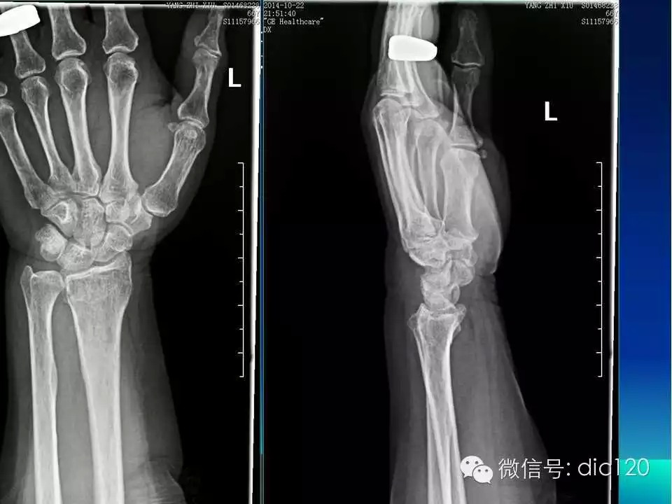 平片容易遗漏的骨折