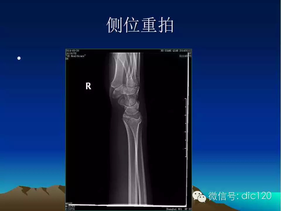 平片容易遗漏的骨折
