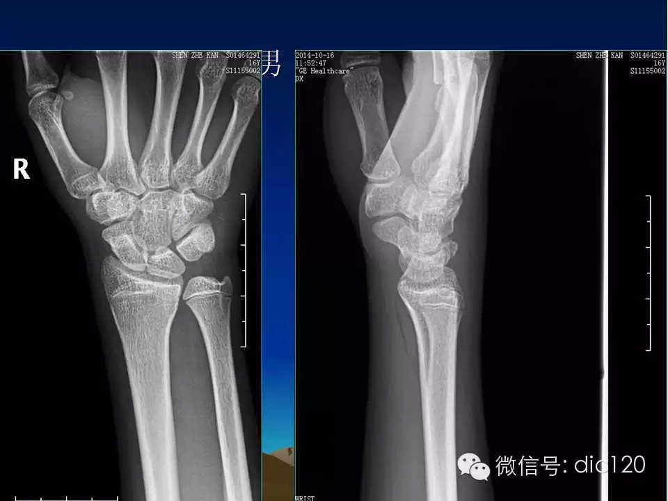 平片容易遗漏的骨折