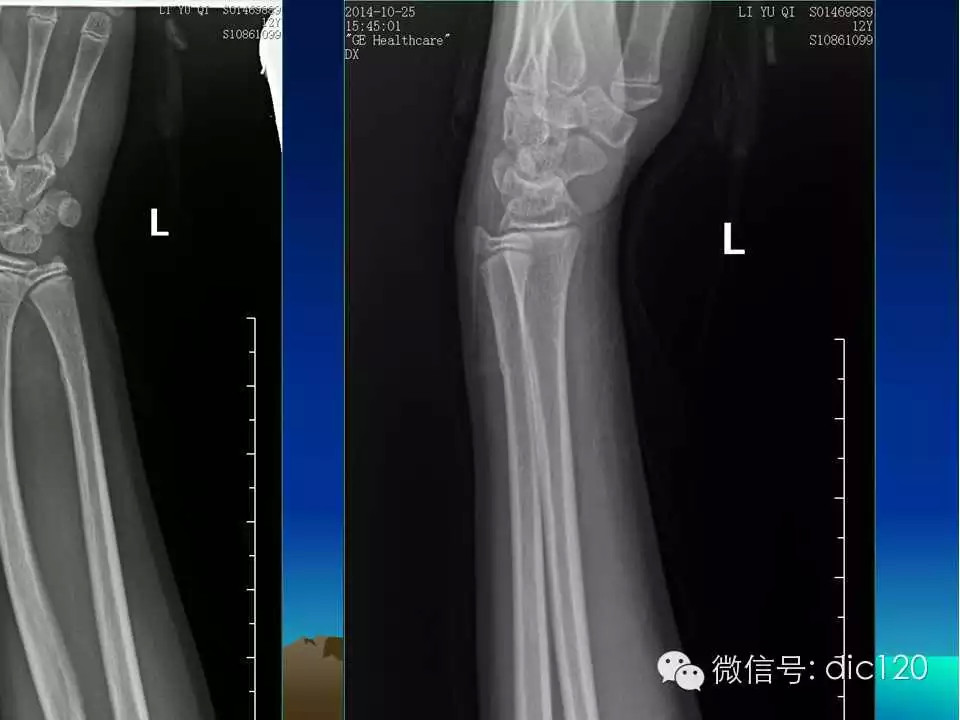 平片容易遗漏的骨折