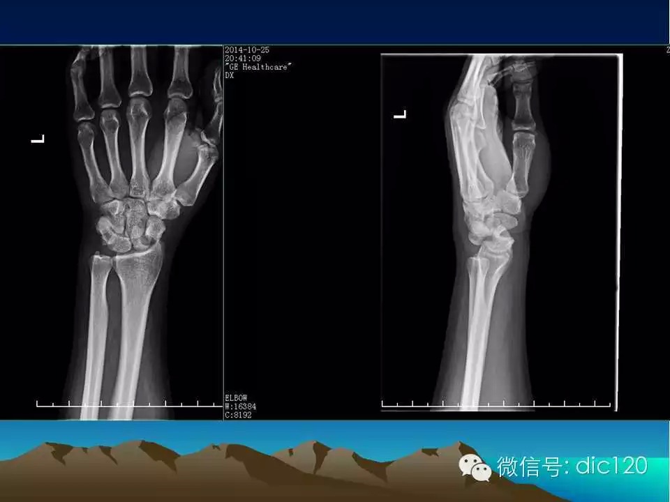平片容易遗漏的骨折