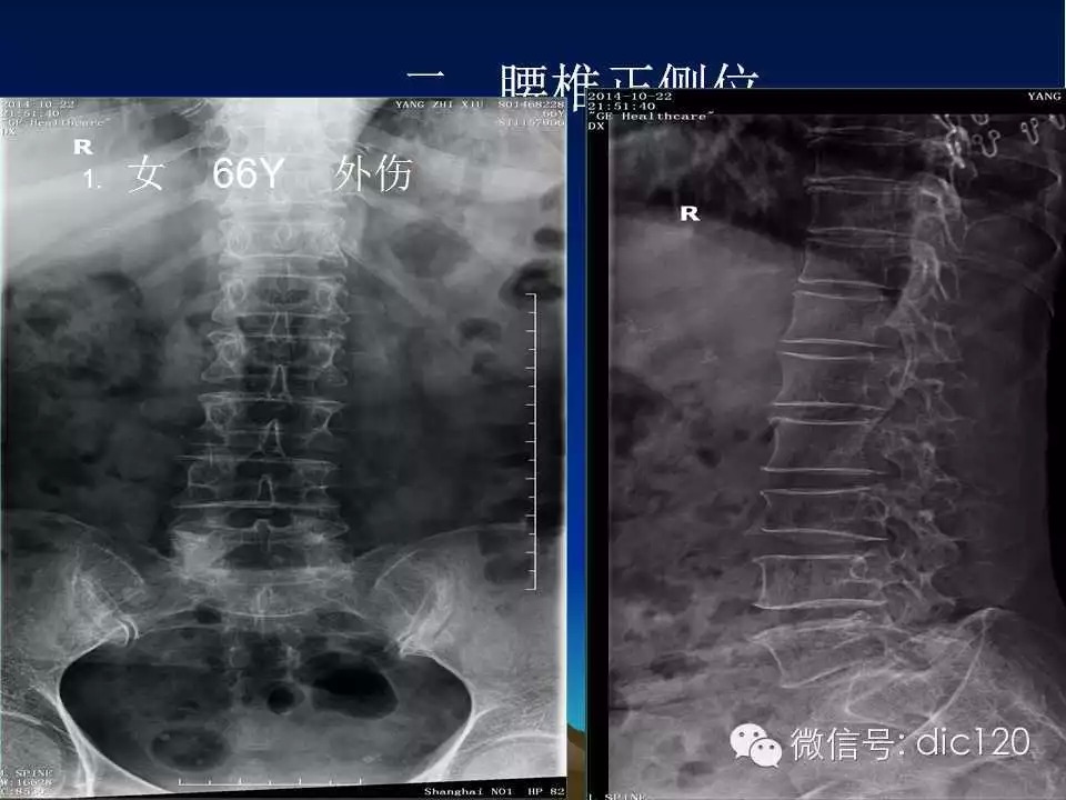 平片容易遗漏的骨折