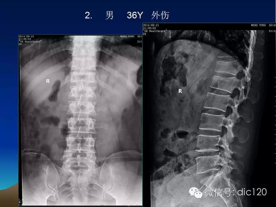 平片容易遗漏的骨折