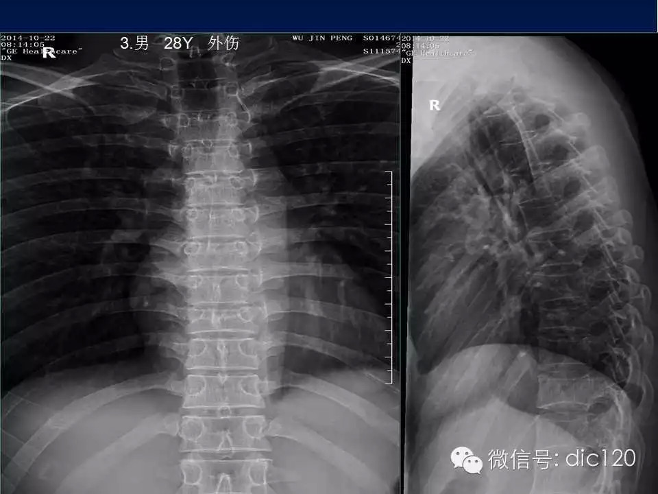 平片容易遗漏的骨折