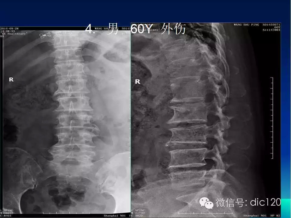 平片容易遗漏的骨折