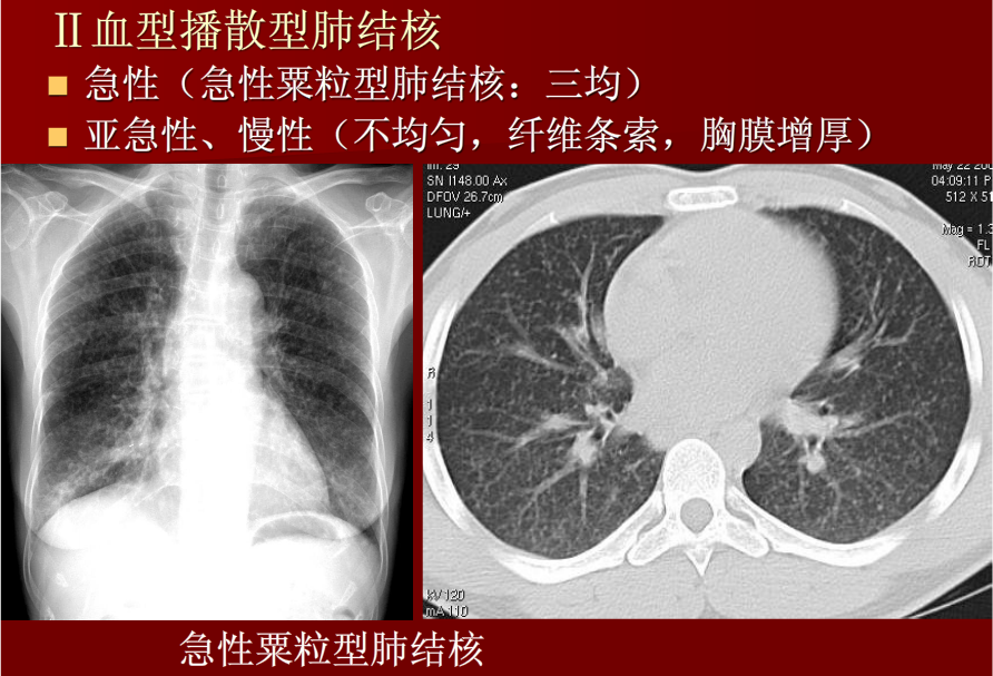 肺炎与肺结核影像诊断