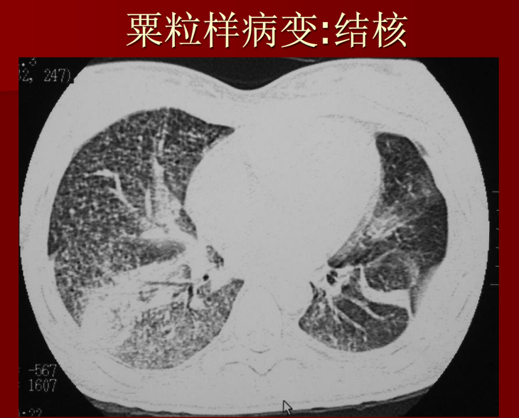 肺炎与肺结核影像诊断
