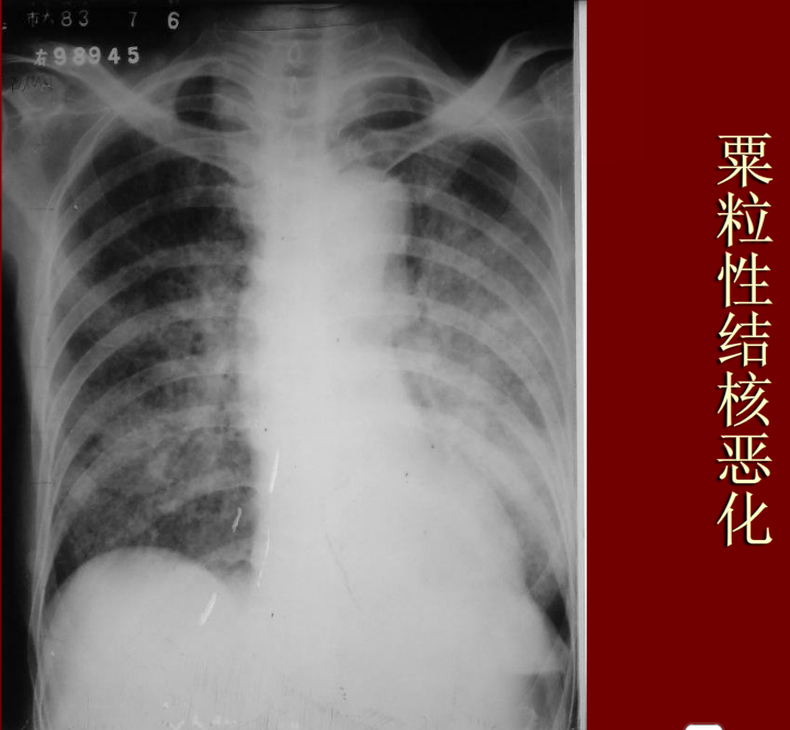 肺炎与肺结核影像诊断
