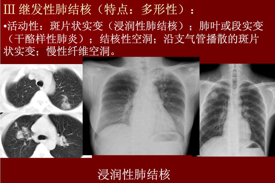 肺炎与肺结核影像诊断