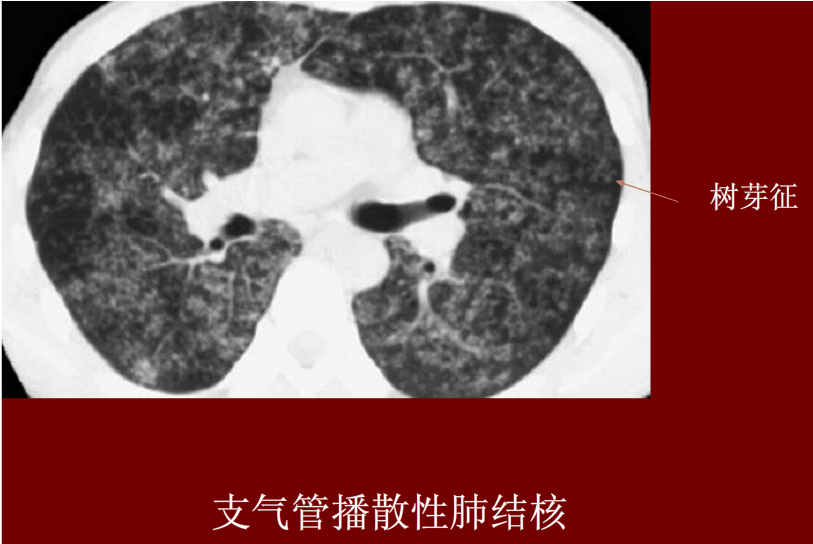 肺炎与肺结核影像诊断