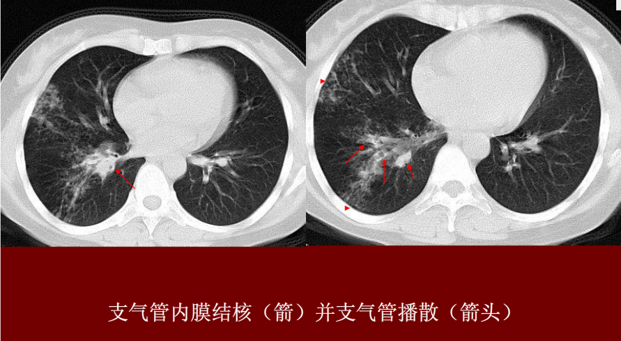 肺炎与肺结核影像诊断