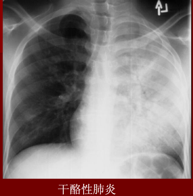 肺炎与肺结核影像诊断