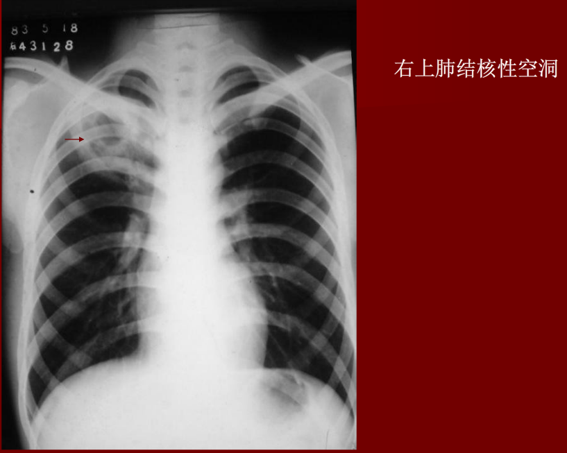 肺炎与肺结核影像诊断
