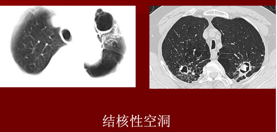 肺炎与肺结核影像诊断