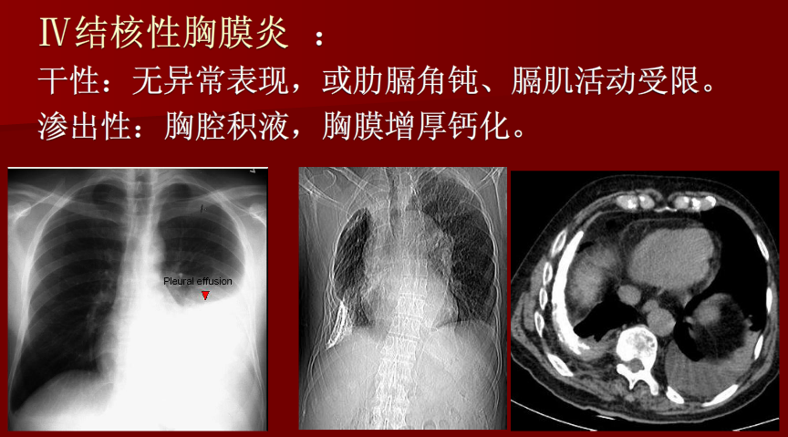 肺炎与肺结核影像诊断