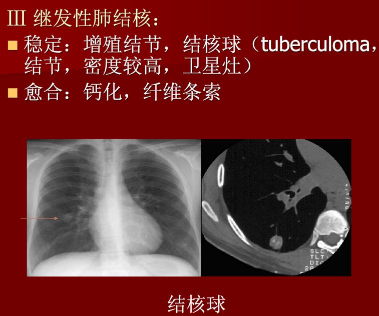 肺炎与肺结核影像诊断
