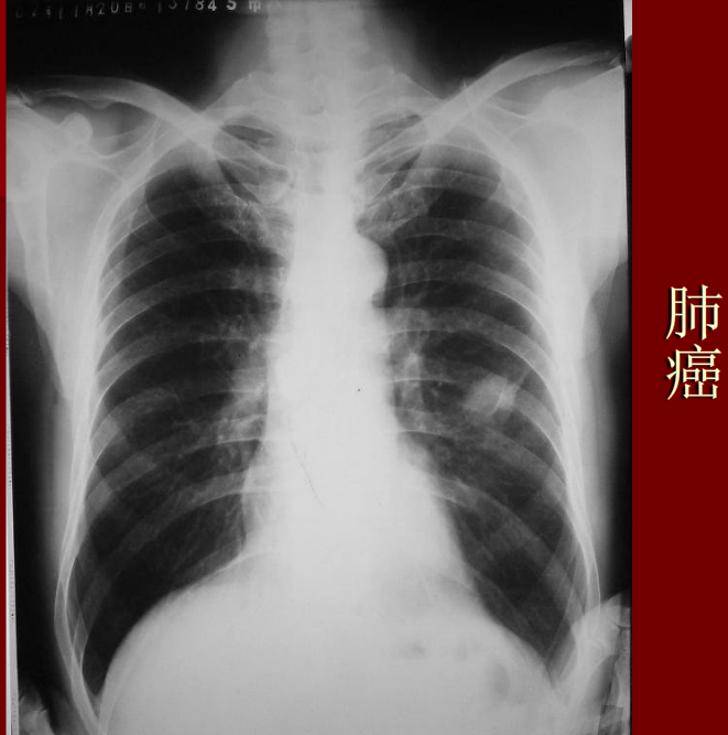 肺炎与肺结核影像诊断