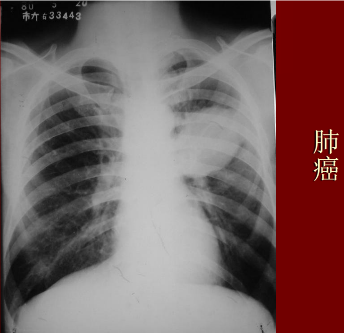 肺炎与肺结核影像诊断