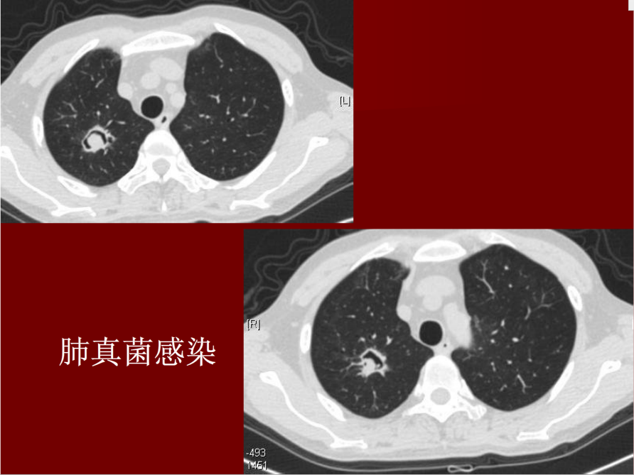 肺炎与肺结核影像诊断