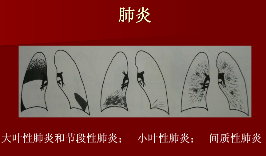 肺炎与肺结核影像诊断