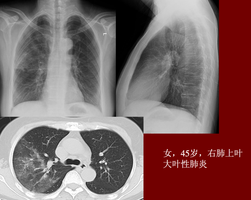 肺炎与肺结核影像诊断