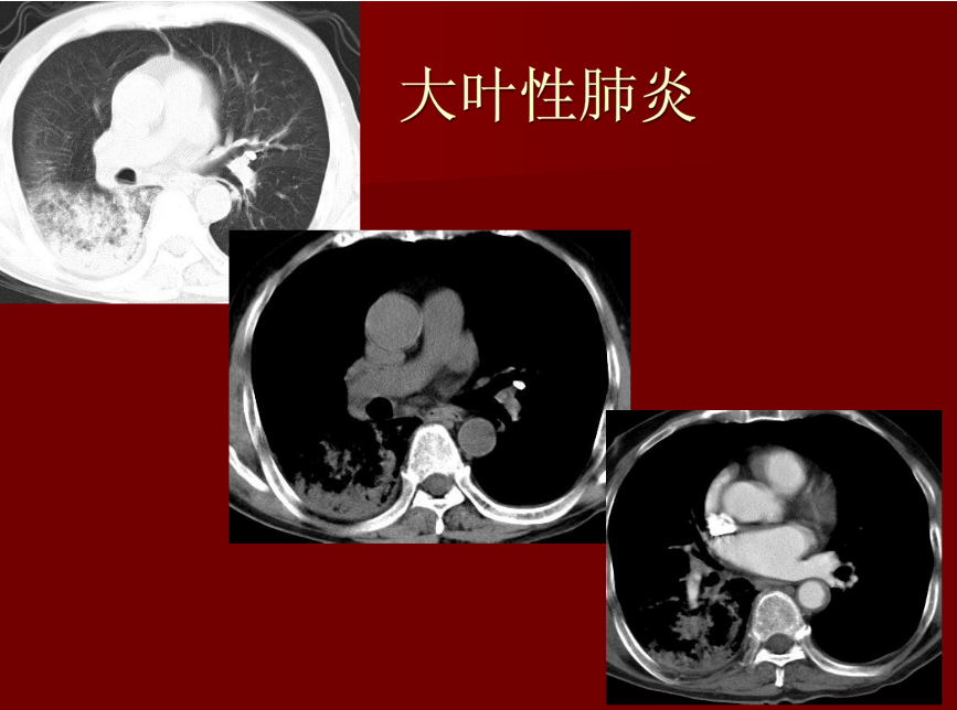 肺炎与肺结核影像诊断