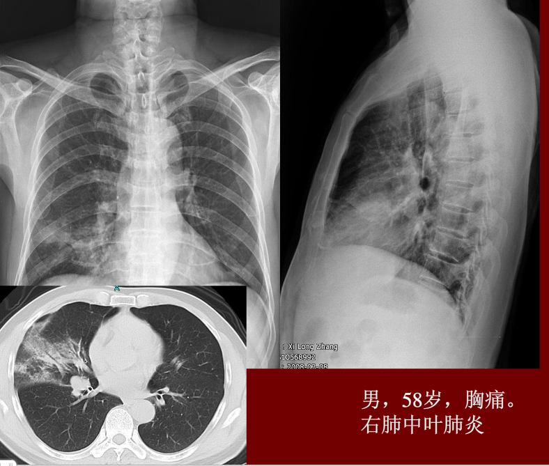 肺炎与肺结核影像诊断