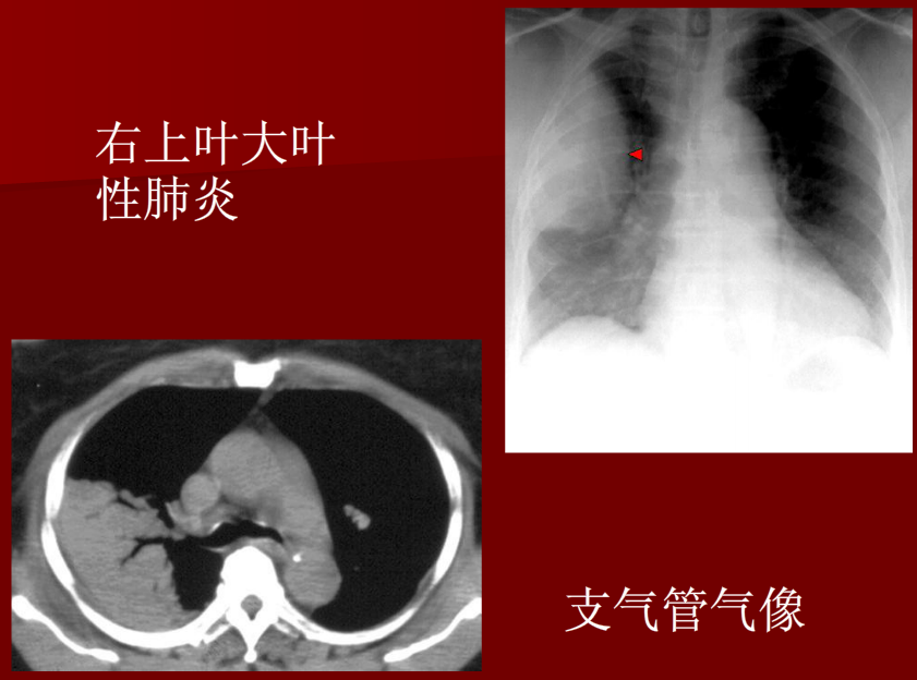 肺炎与肺结核影像诊断