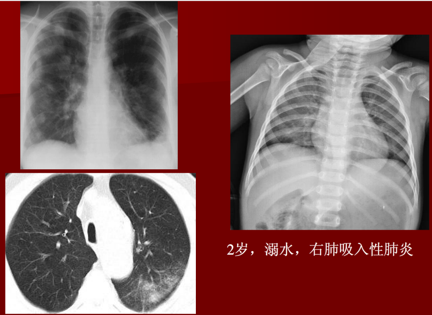 肺炎与肺结核影像诊断