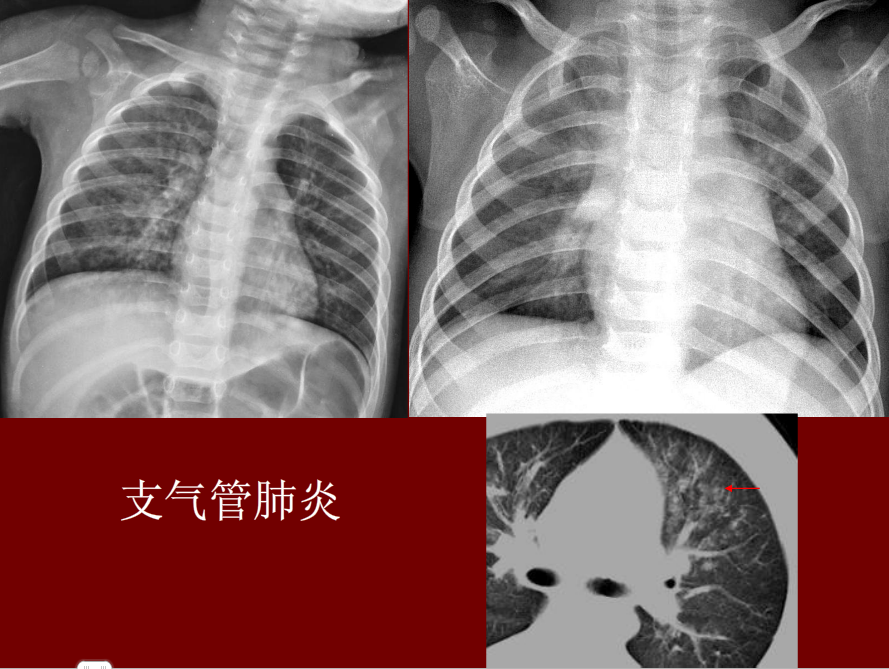 肺炎与肺结核影像诊断