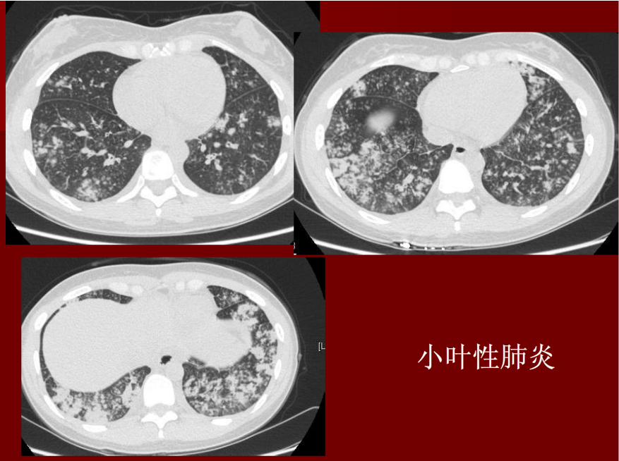 肺炎与肺结核影像诊断