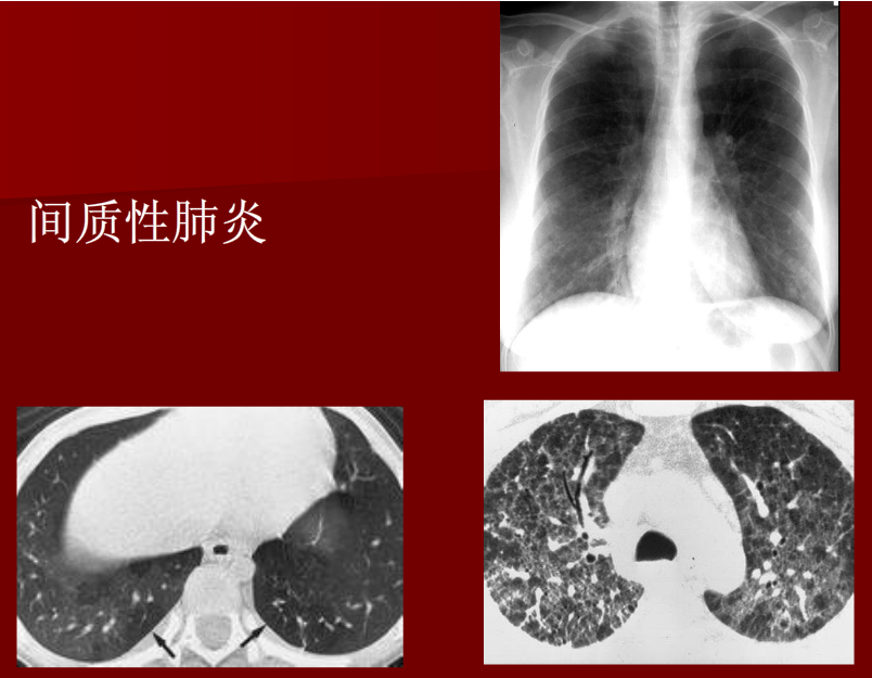 肺炎与肺结核影像诊断