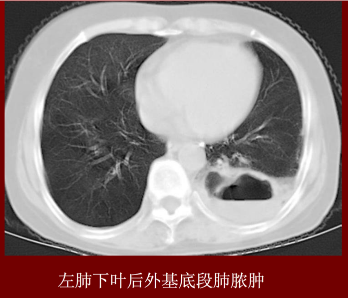 肺炎与肺结核影像诊断