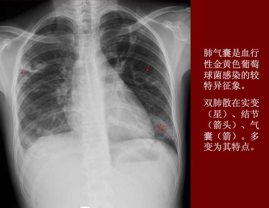 肺炎与肺结核影像诊断