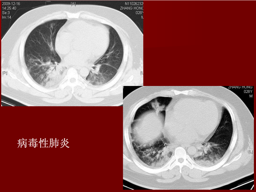 肺炎与肺结核影像诊断