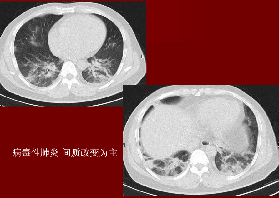 肺炎与肺结核影像诊断
