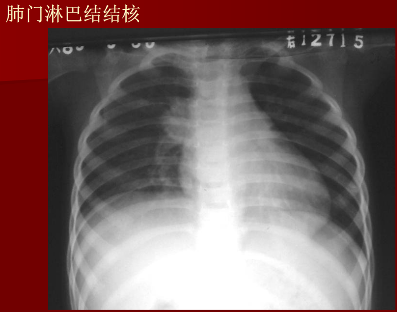肺炎与肺结核影像诊断