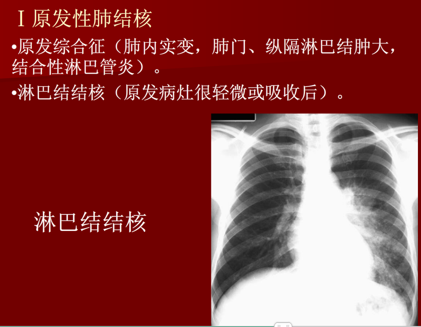 肺炎与肺结核影像诊断
